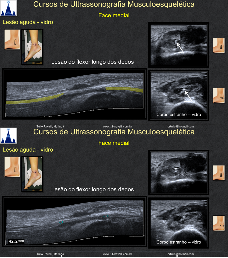 tendão flexor longo dos dedos
